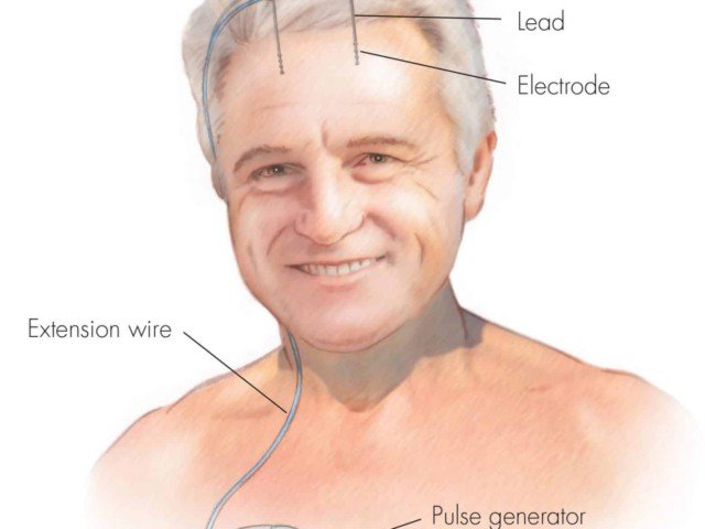 What is Deep Brain Stimulation? How does DBS work? Deep Brain Stimulation for Movement Disorders – drkharkar