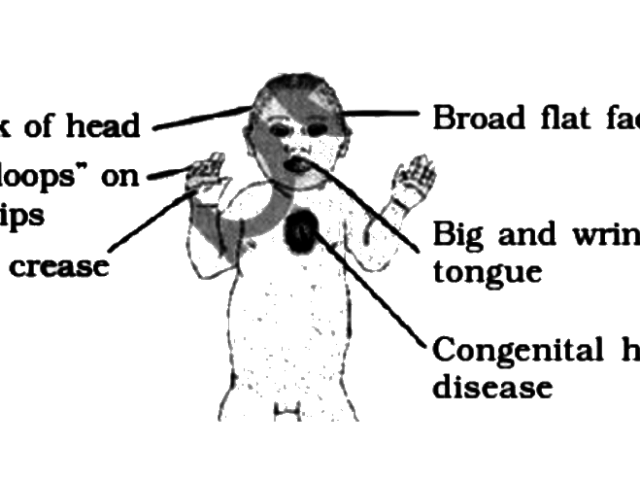 What are “Epilepsy Syndromes”?,  Classification and Definition of Epilepsy Syndromes – Drkharkar