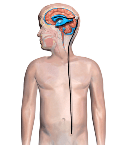 Hydrocephalus Shunt Child e1598638591230