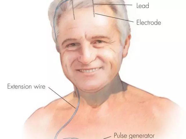 deep brain stimulation banner