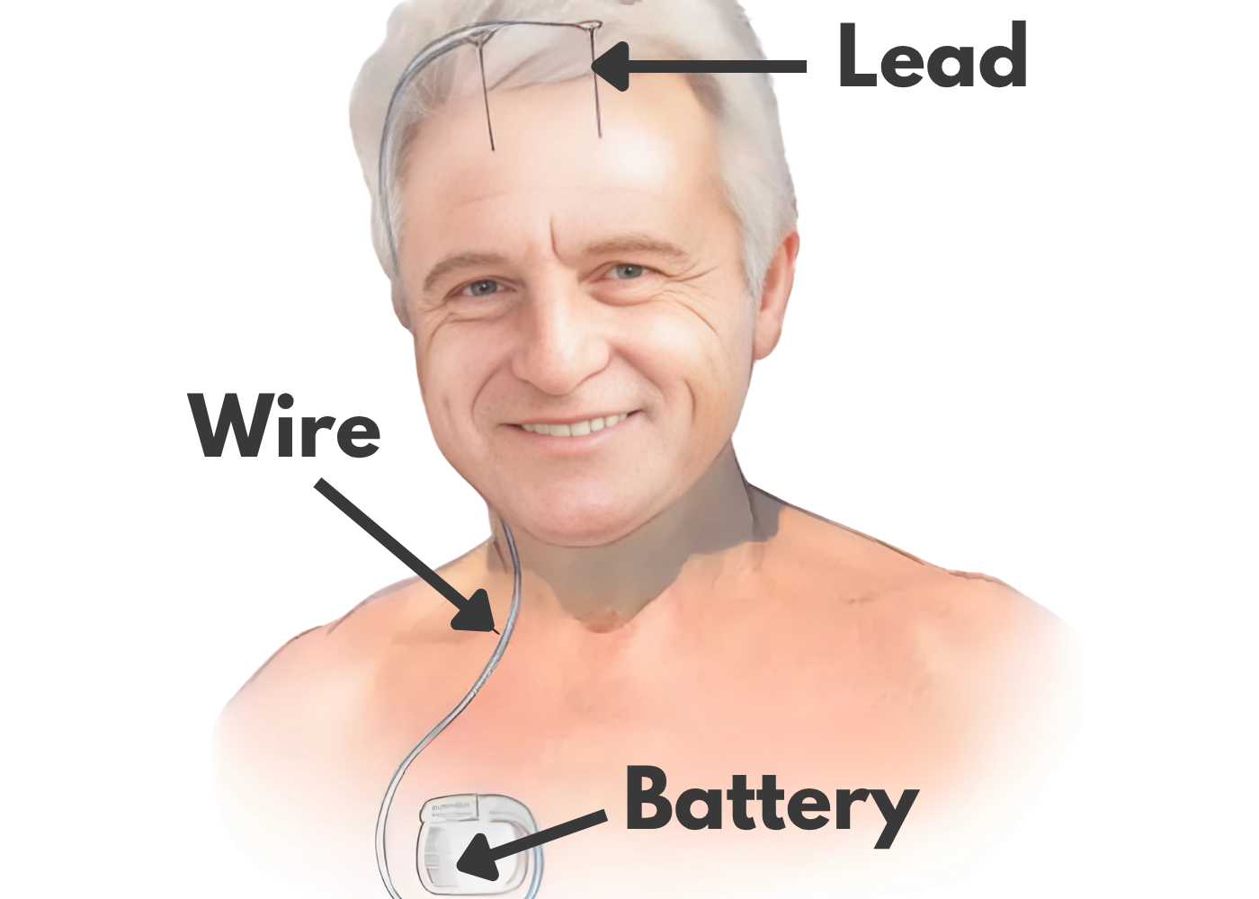 Deep Brain Stimulation For Parkinsons Illustration