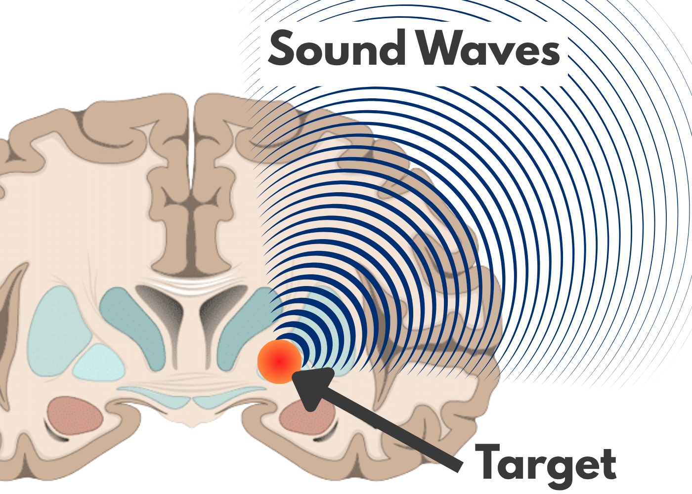MRI guided fractioned ultrasound - MRGFUS for parkinson's