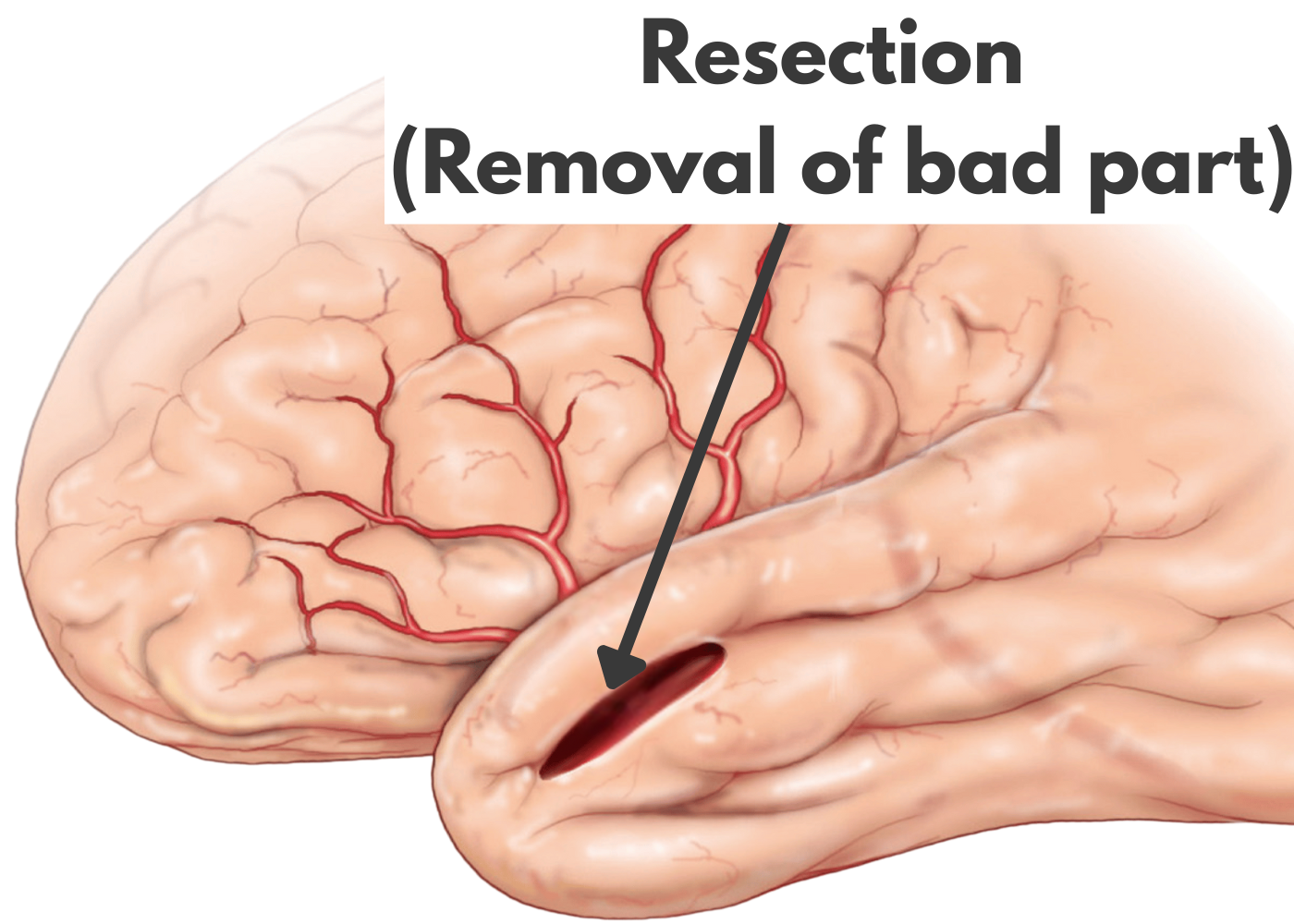 Resective Epilepsy Surgery