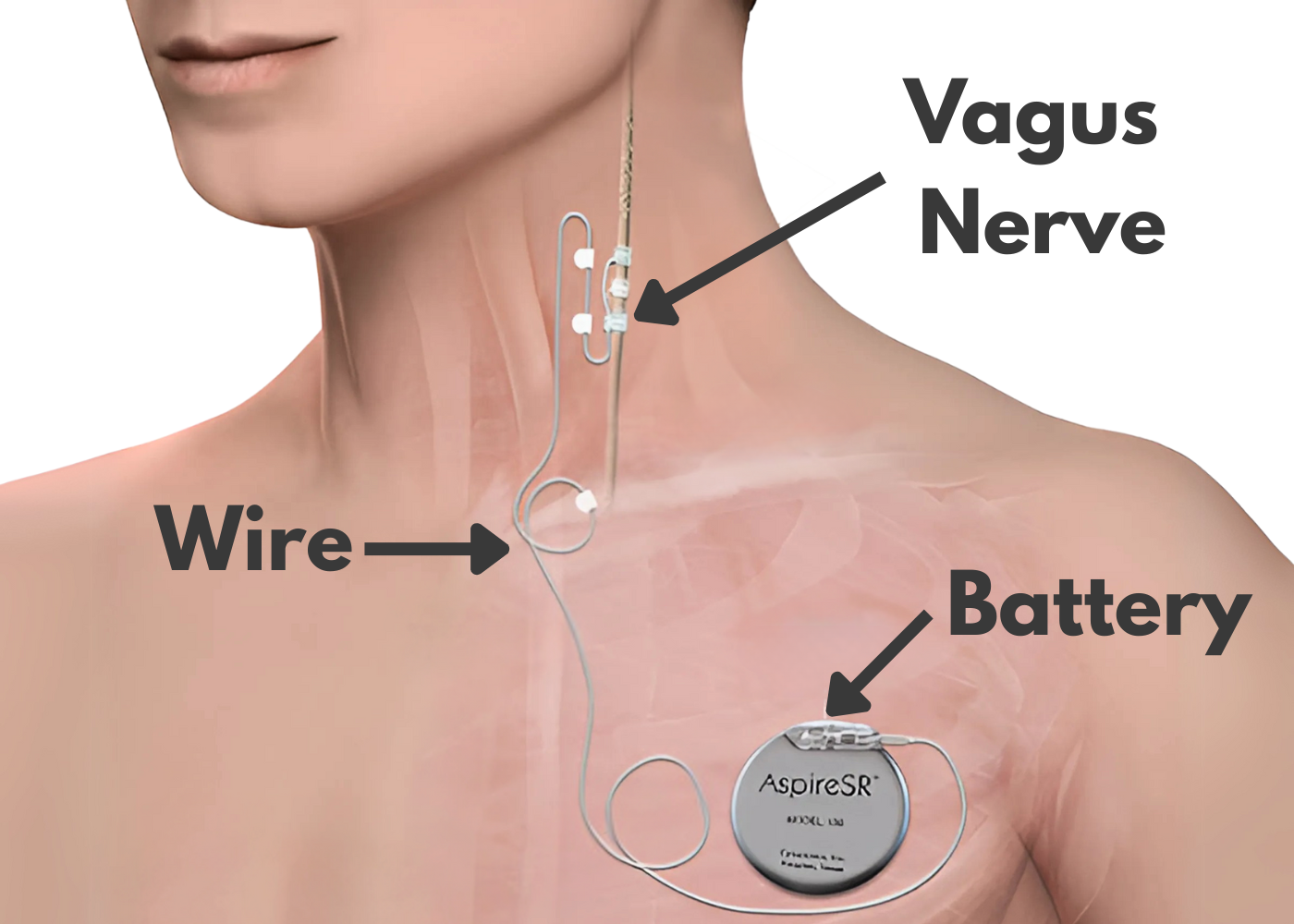 Vagus Nerve Stimulation Illustration