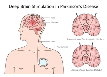 Dbs in Parkinson's Disease