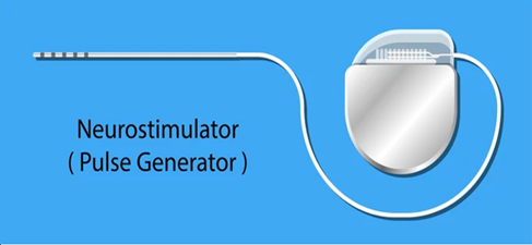 Neurostimulator Illustration