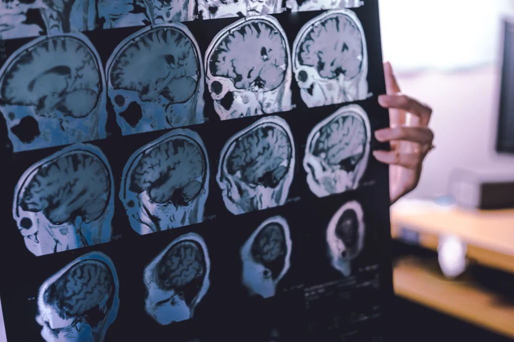 Forgetfulness vs Dementia: When to Worry About Memory Loss 2 Forgetfulness vs Dementia