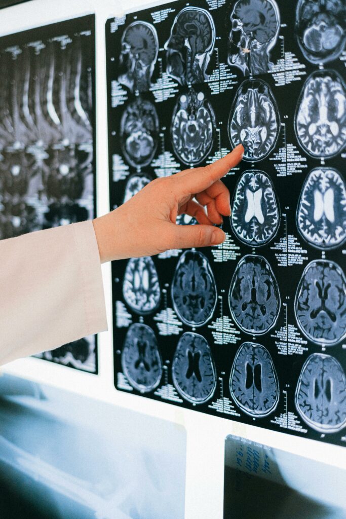 Multiple Sclerosis Treatment in Thane 2
