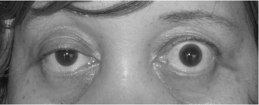 Myasthenia Gravis: Early Symptoms Patients Often Miss 3 Myasthenia Gravis - Early Symptoms Patients Often Miss