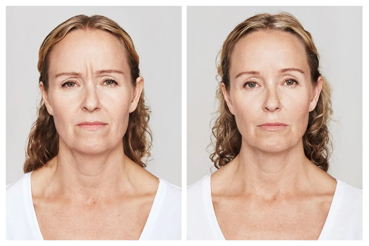 Myasthenia Gravis: Early Symptoms Patients Often Miss 4 Myasthenia Gravis Early Symptoms