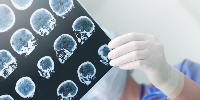 First Seizure in Adults: What to Do Next 4 Safety steps after a first seizure in adults