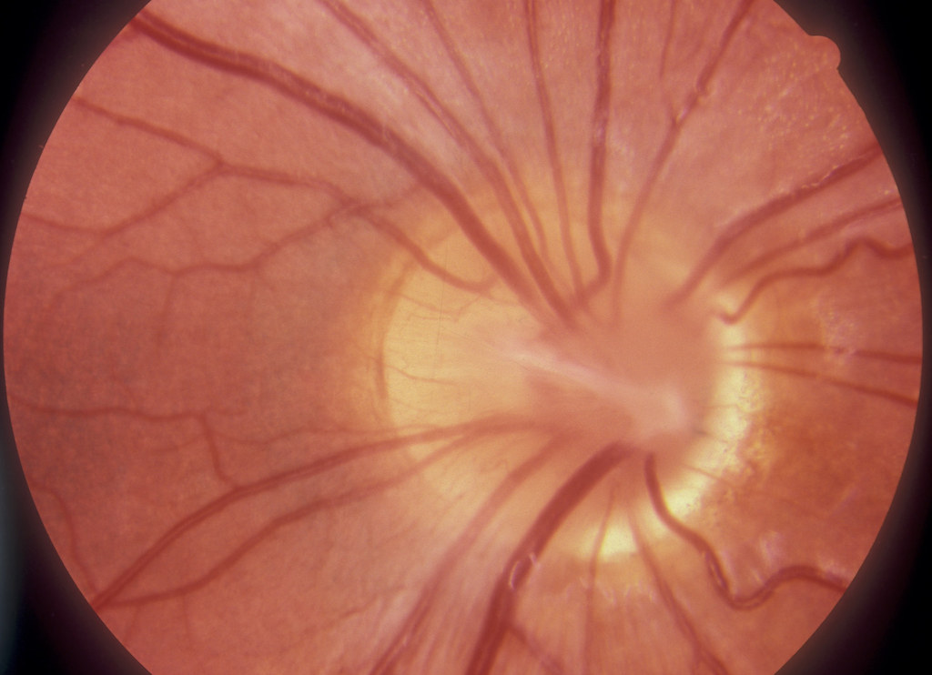 Optic Neuritis: Can Vision Problems Be a Neurological Sign? 3 Can Vision Problems Be a Neurological Sign
