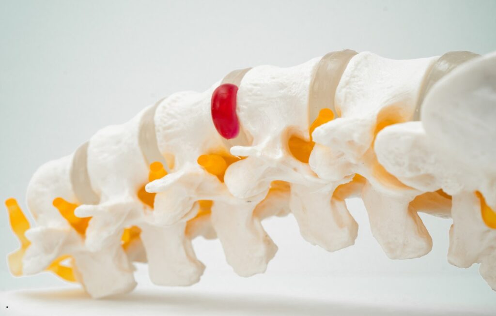 Cervical Myelopathy Warning Signs You Should Not Ignore 3 Cervical Myelopathy Warning