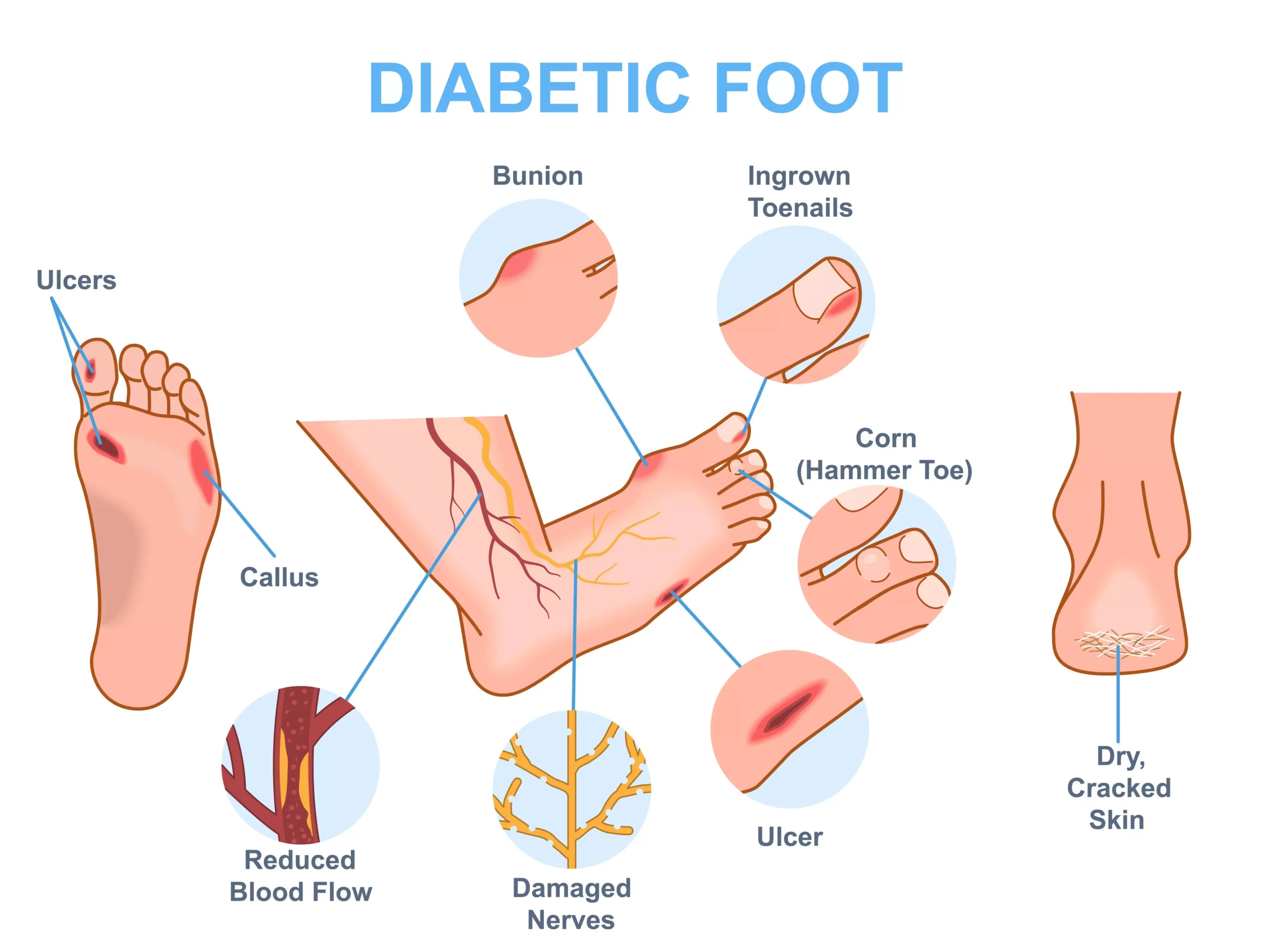 Diabetic Neuropathy Symptoms: When to See a Neurologist 3 Diabetic Neuropathy Symptoms