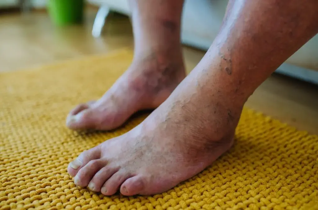 Diabetic Neuropathy Symptoms: When to See a Neurologist 4 Diabetic Neuropathy