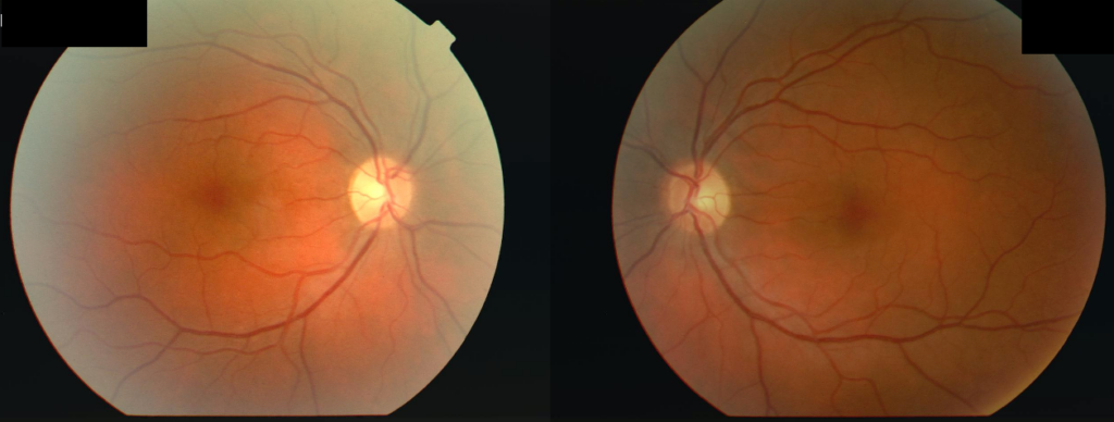 Optic Neuritis: Can Vision Problems Be a Neurological Sign? 2 Optic Neuritis - Can Vision Problems Be a Neurological Sign