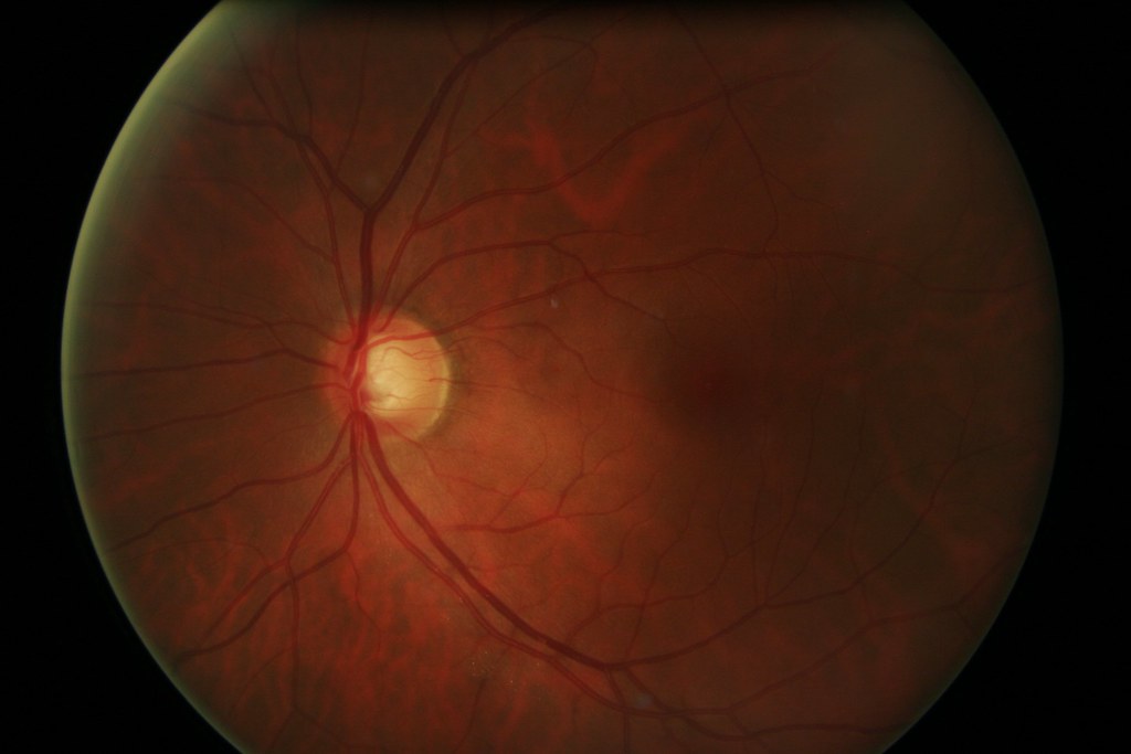 Optic Neuritis: Can Vision Problems Be a Neurological Sign? 4 Optic Neuritis