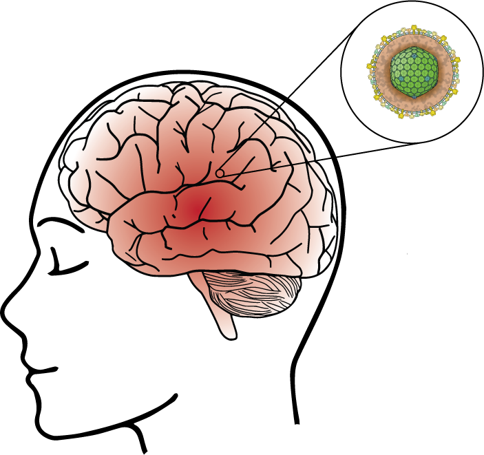 Encephalitis Symptoms in Adults: Early Signs You Should Not Ignore 2 Seizure symptoms in adults