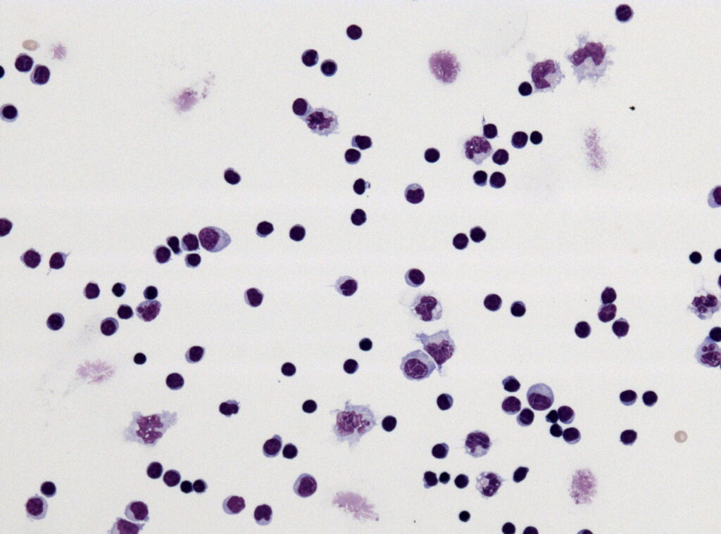 Encephalitis Symptoms in Adults: Early Signs You Should Not Ignore 4 Stroke symptoms and when to act fast