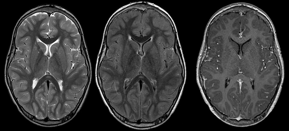 Encephalitis Symptoms in Adults: Early Signs You Should Not Ignore 3 TIA symptoms and warning signs