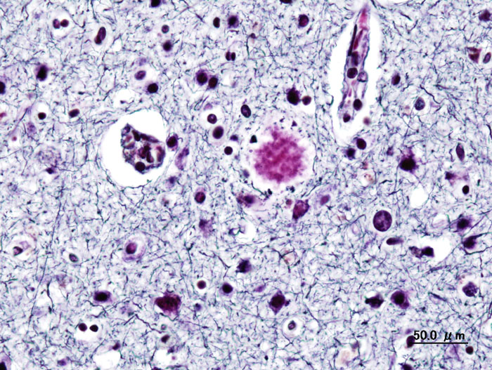Early Signs of Alzheimer’s Disease: Symptoms Families Should Not Ignore 4