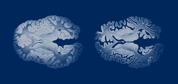 Early Signs of Alzheimer’s Disease: Symptoms Families Should Not Ignore 3 Early Signs of Alzheimer's