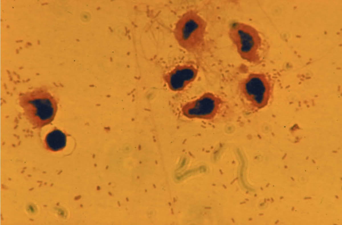Meningitis Warning Signs in Adults: Early Symptoms You Should Not Ignore 4 Meningitis Warning Signs in Adults - Early Symptoms You Should Not Ignore