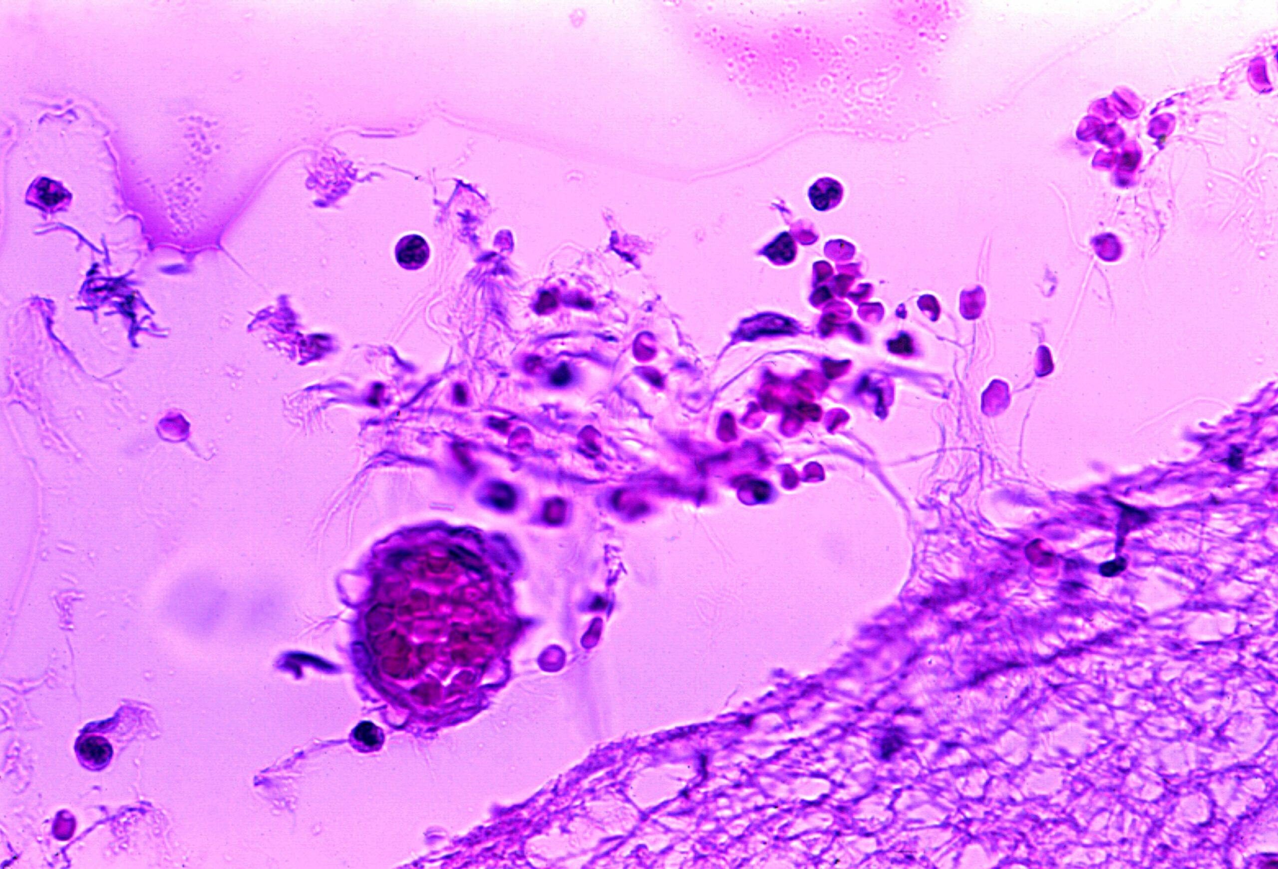 Meningitis Warning Signs in Adults: Early Symptoms You Should Not Ignore 3 Mild meningitis with hemorrhage due to bacillus anthracis