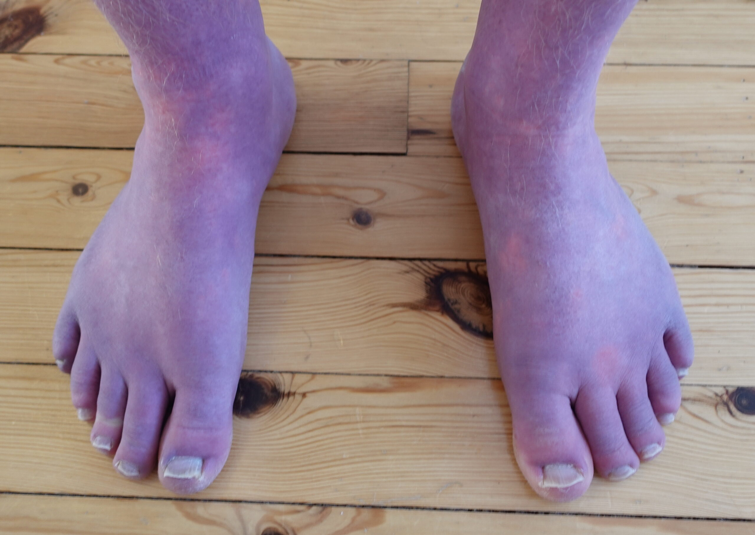 Restless Legs Syndrome: Neurological Causes and Treatment 3 Restless Legs Syndrome