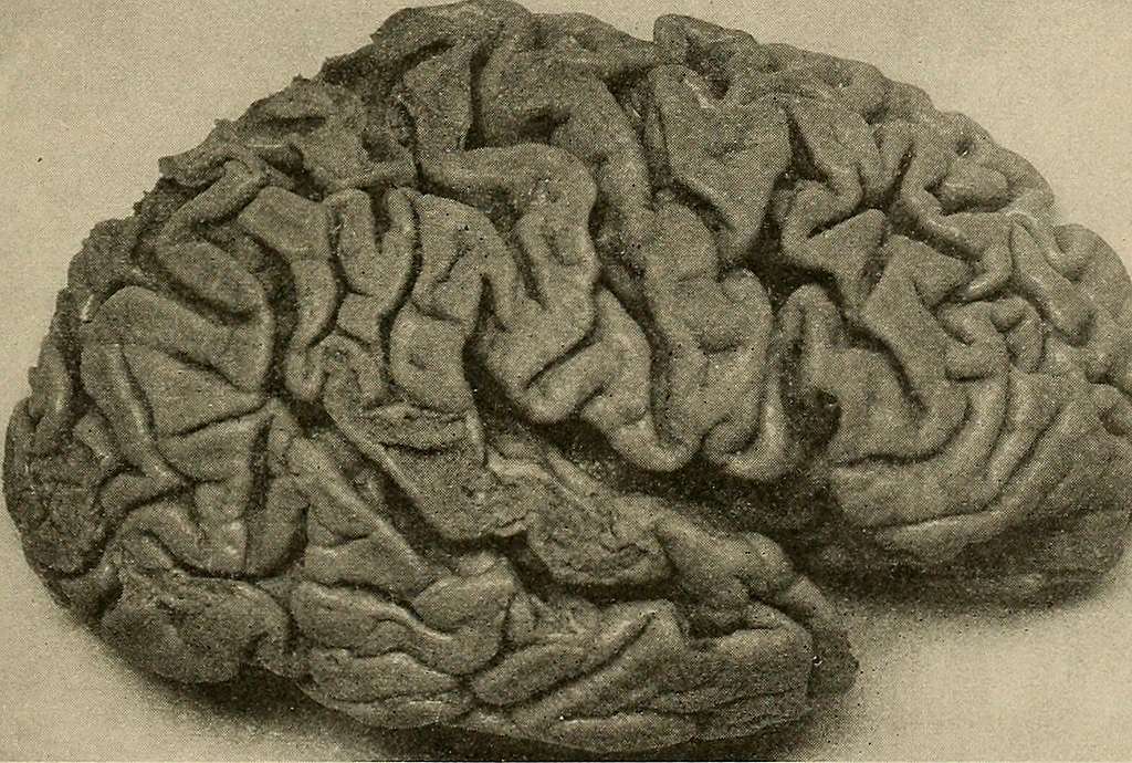 Common Seizure Triggers and How to Avoid Them 4 Seizure Triggers