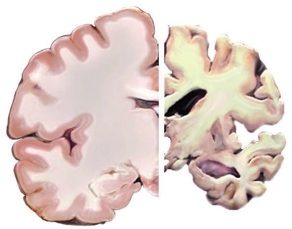 Early Signs of Alzheimer’s Disease: Symptoms Families Should Not Ignore 4 Early Signs of Alzheimer’s Disease: Symptoms Families Should Not Ignore
