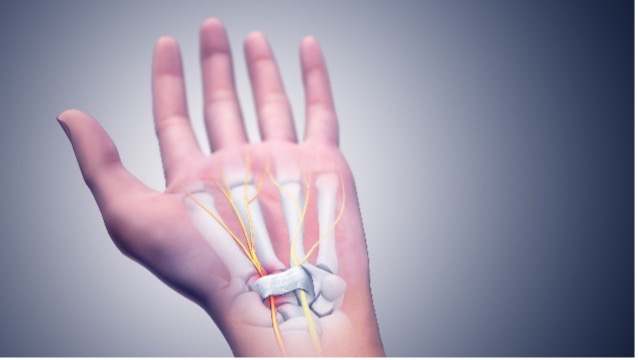 Carpal Tunnel vs Cervical Radiculopathy vs Neuropathy: How to Tell the Difference 2