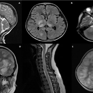 Transverse Myelitis Symptoms and When to Seek Help 3 Transverse Myelitis Symptoms