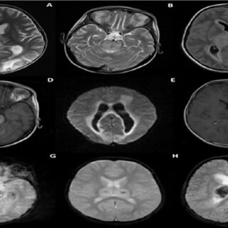 Transverse Myelitis Symptoms and When to Seek Help 4 Transverse Myelitis