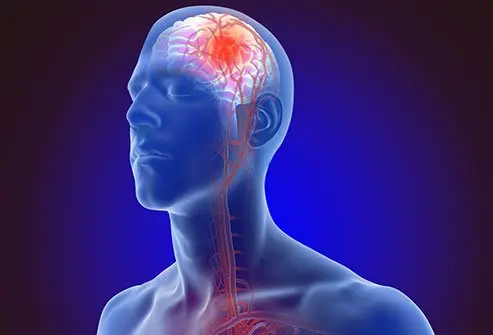 How to Reduce the Risk of a Second Stroke 2 How to Reduce the Risk of a Second Stroke