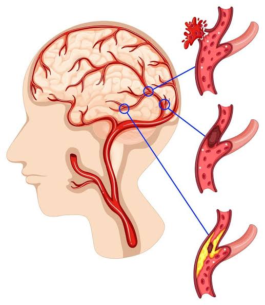 How to Reduce the Risk of a Second Stroke 4 Risk of a Second Stroke